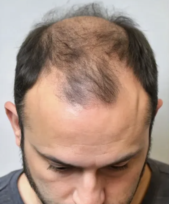 Hair loss before treatment